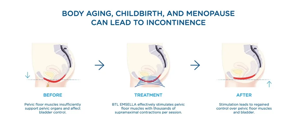 Body ageing, childbirth and menopause can lead to incontinence: before, during and after EMSella treatment